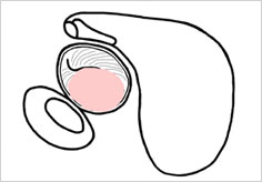 外耳鼓膜保存型鼓室形成術
