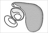外耳道鼓膜保存型鼓室形成術の流れ