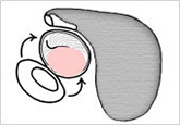 外耳道鼓膜保存型鼓室形成術の流れ